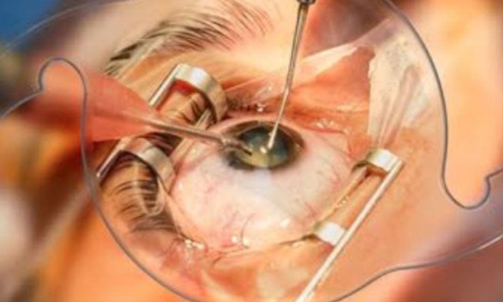Cataract surgery