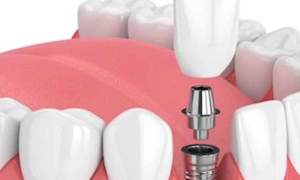 Dental Implants
