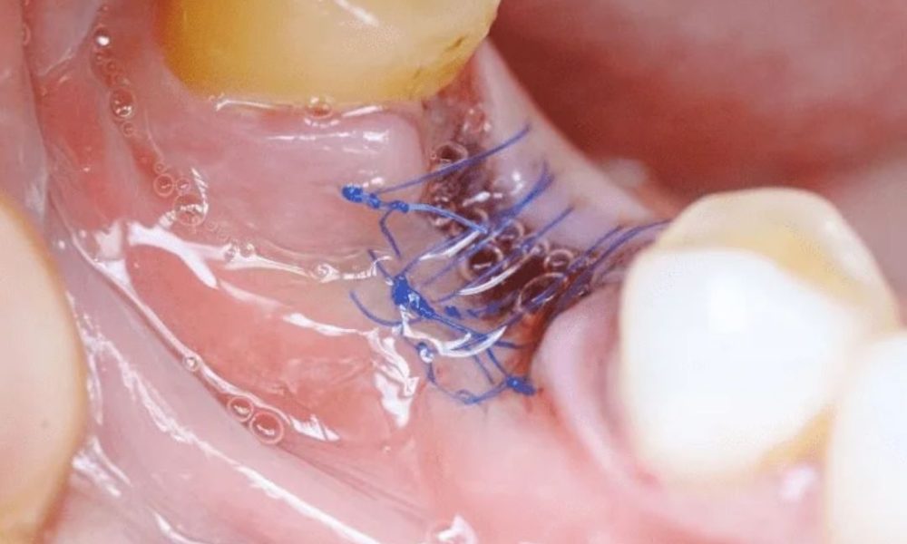 Wisdom Tooth Surgery